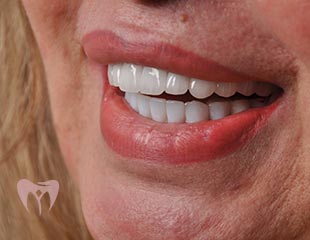 Smile Makeover Treatments