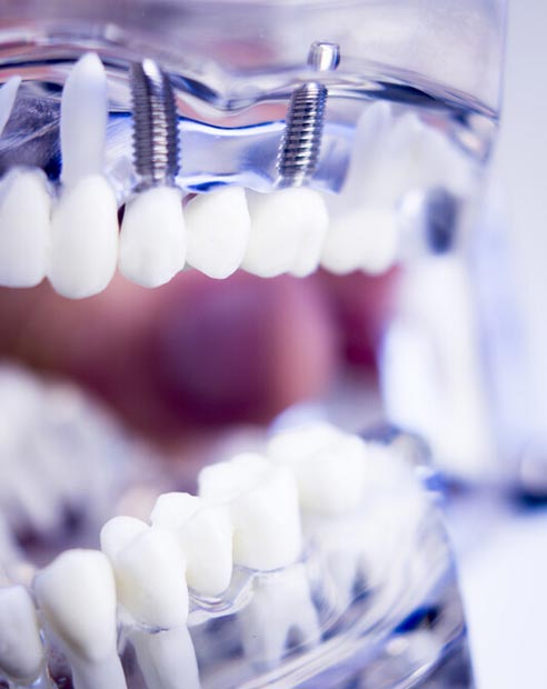 Dental Implants in Turkey