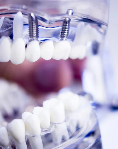 Dental Implants in Turkey