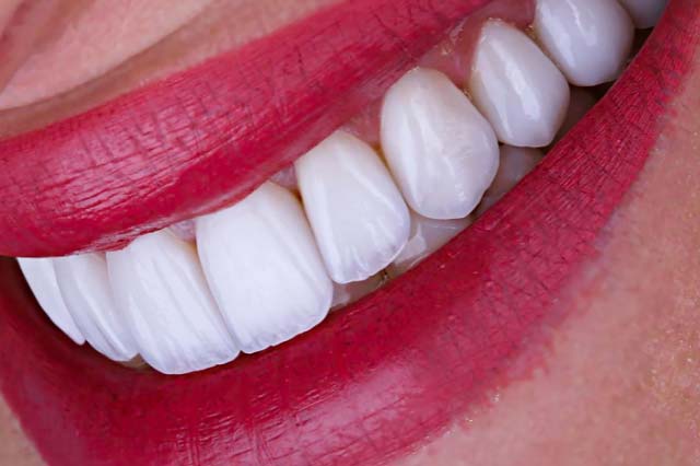 Porcelain Veneers & Lumineers