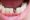 What Are The Stages Of A Dental Implant Turkey?