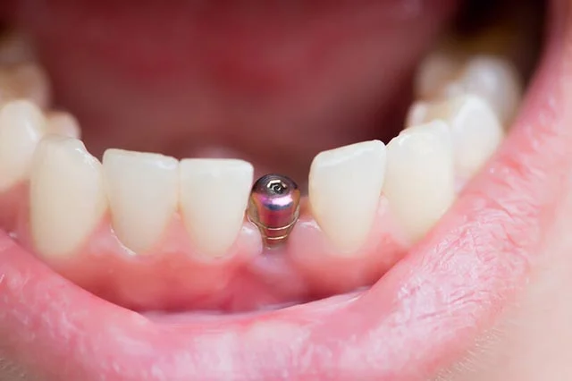 What Are The Stages Of A Dental Implant Turkey?