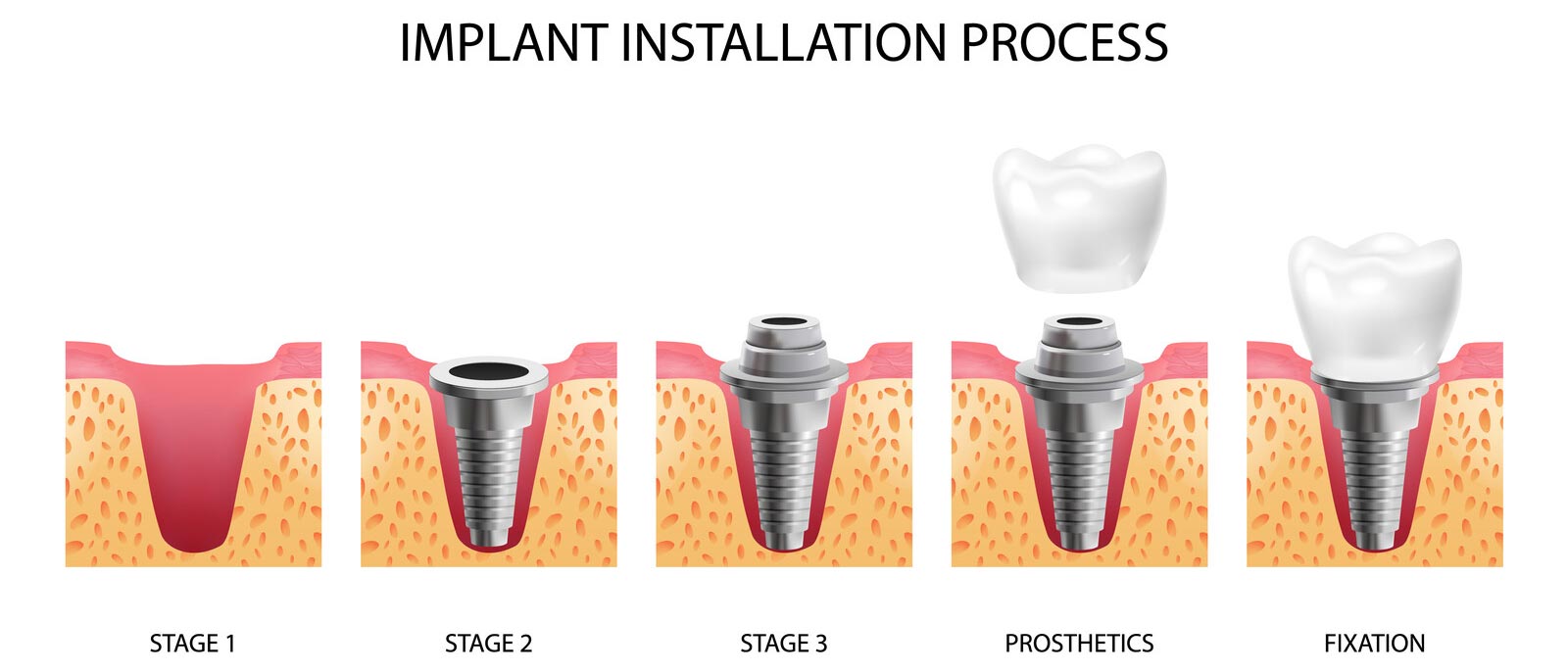 What is a dental implant and how is it done?