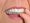 clear-braces