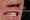 dental-bridge