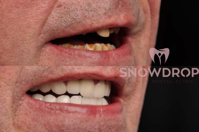 dental-bridge