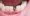 What Are Dental Implant