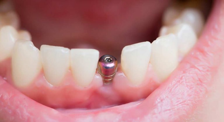 What Are Dental Implant