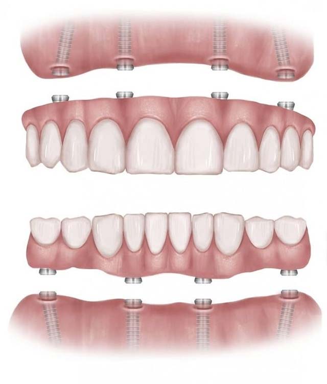 all-on-4-dental-implants