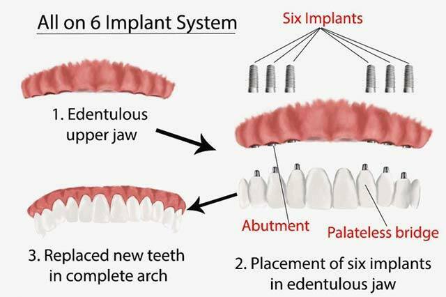 all-on-6-implants-turkey