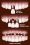 all-on-six-dental-implants