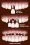 all-on-six-dental-implants