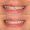 Broken Tooth Repair With Composite Filling