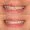 Broken Tooth Repair With Composite Filling
