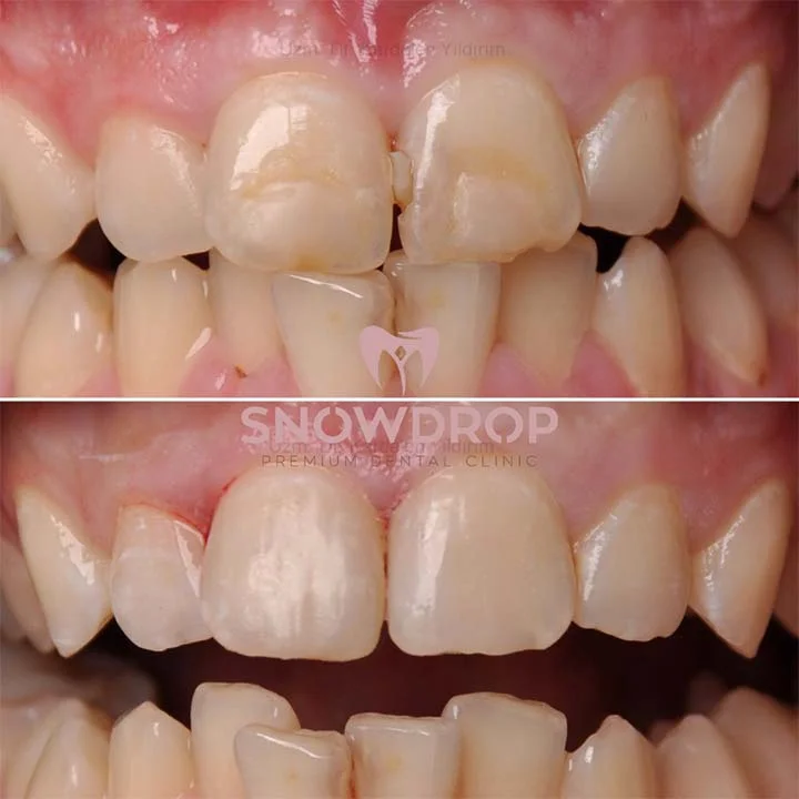 Cosmetic Composite Filling