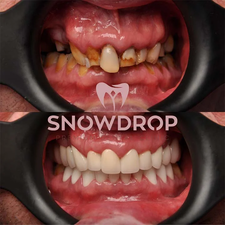 Bite Correction With Zirconium Crowns