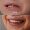 Smile Makeover