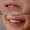 Smile Makeover