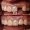Single Dental Crown