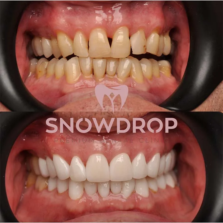 Snowdrop Dental Veneers