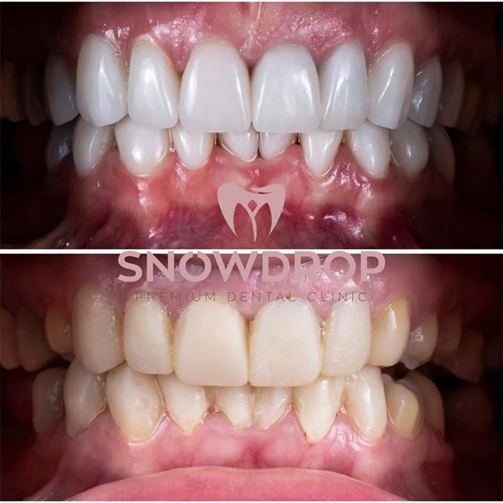 Snowdrop Porcelain Veneers
