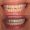 eMax Veneers For Upper And Lower Two Front Teeth