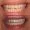 eMax Veneers For Upper And Lower Two Front Teeth