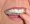 invisalign