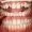 Porcelain Laminate Veneers