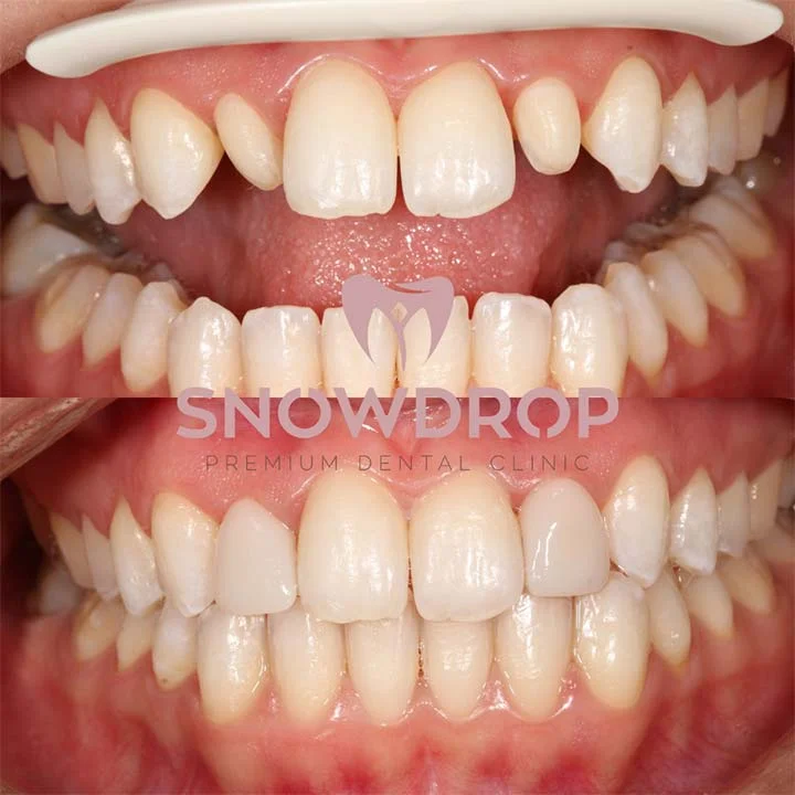 Porcelain Laminate Veneers