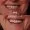 Laser Teeth Whitening