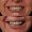 Gum Contouring and Dental Crowns