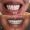 Zirconium Crowns