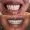 Zirconium Crowns