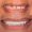 Zirconium Crowns For Upper Teeth